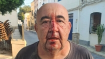 Rompen la nariz con una piedra a Jos&eacute; Manuel Gil, concejal de Alsodux